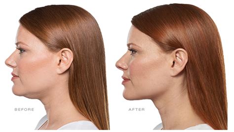 A Comprehensive Guide To Belkyra (Kybella) Treatment.